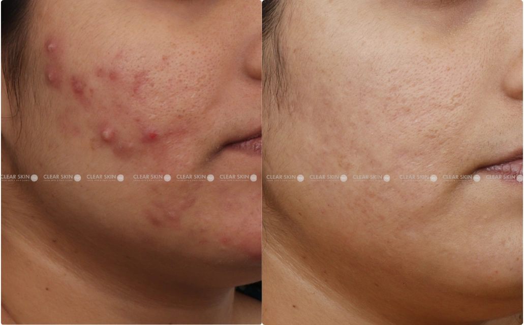 Acne Results 6 Sessions 7 Months ClearSkin Pune