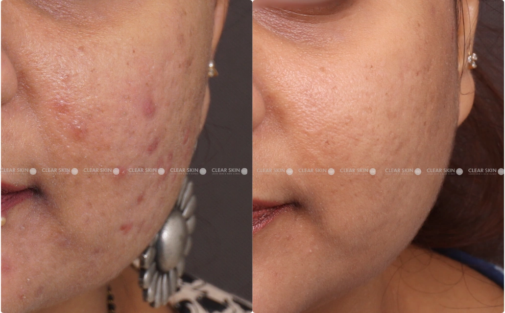 Acne Results 7 Sessions 6 Months ClearSkin Pune