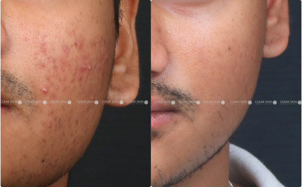 Acne Results 7 Sessions 6 Months ClearSkin Pune