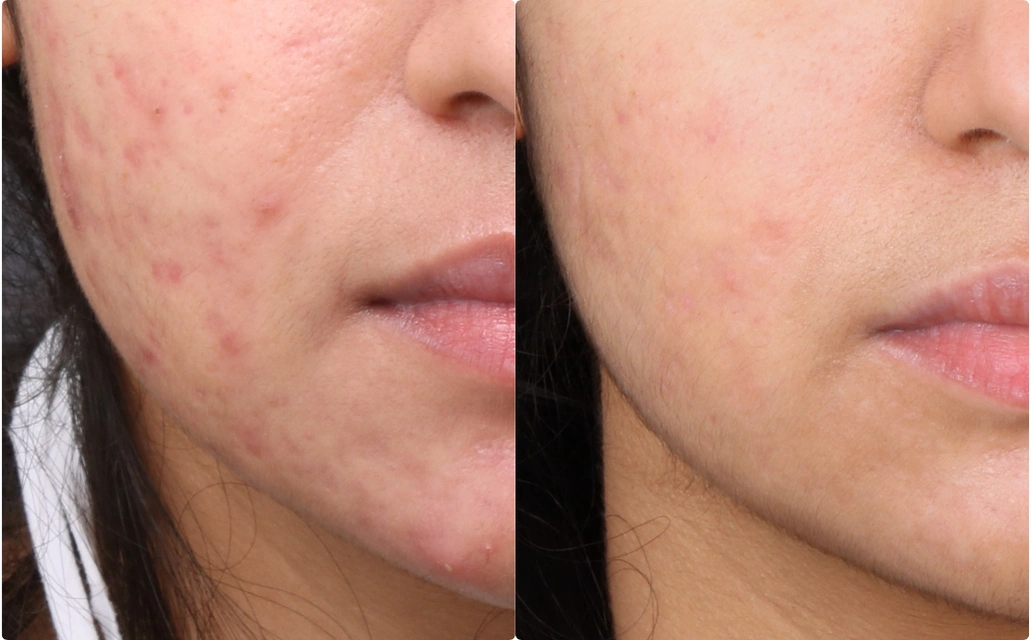 Acne Scars Results 3 Months 4 Sessions ClearSkin Pune