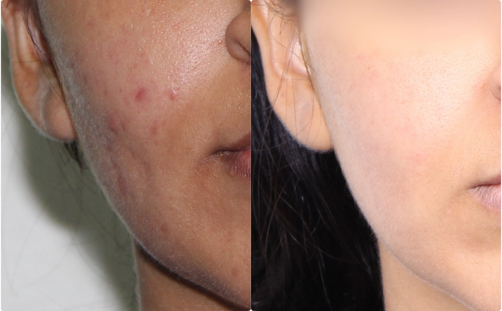 Acne Scars Results 4 Months 6 sessions ClearSkin Pune Acne Scars