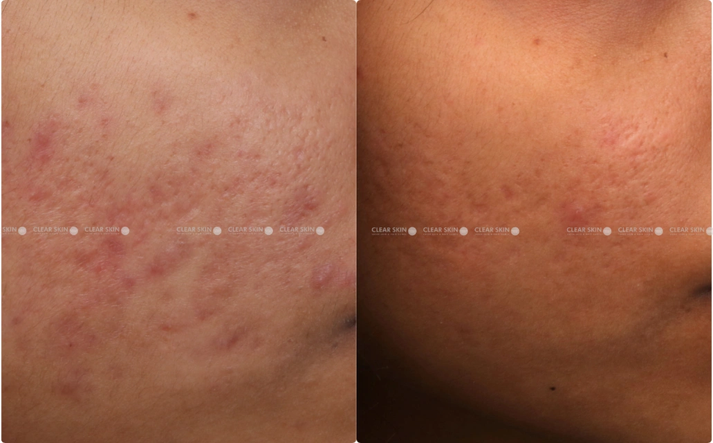 Acne Scars Results 6 Months 5 Sessions ClearSkin Pune