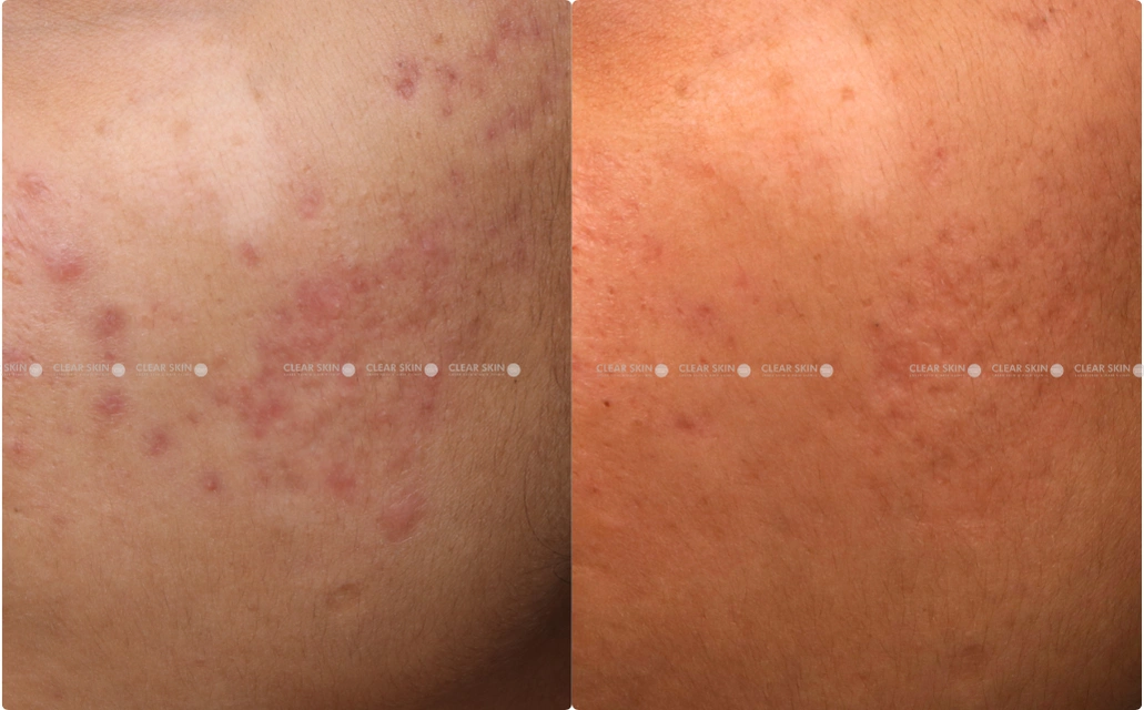 Acne Scars Results 6 Months 6 Sessions ClearSkin Pune