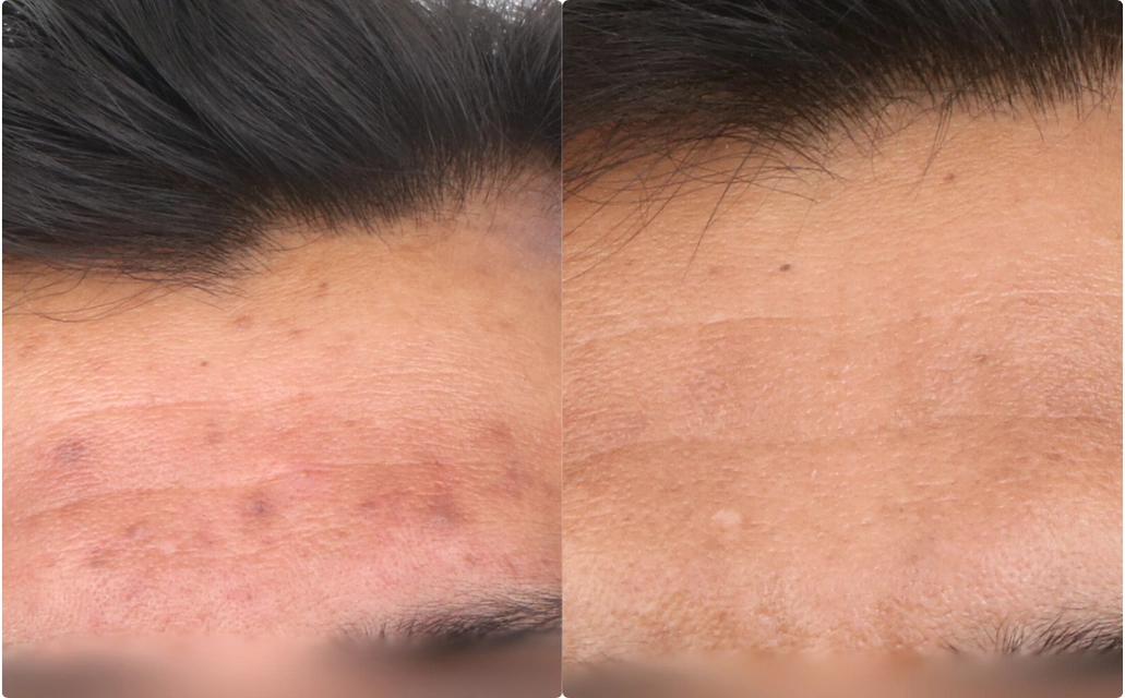 Acne Scars Results 6 Months 6 Sessions ClearSkin Pune