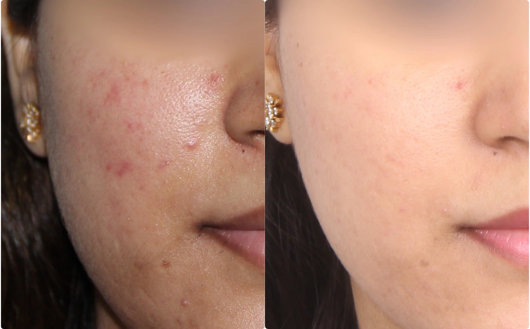 Acne Scars Results 6 Months 6 Sessions ClearSkin Pune