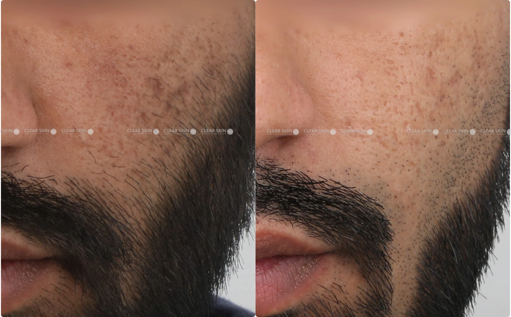 Acne Scars Results 6 Months 6 Sessions ClearSkin Pune