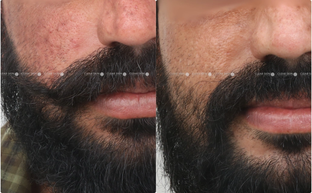 Acne Scars Results 6 Months 6 Sessions ClearSkin Pune