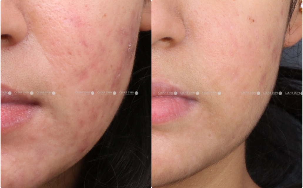 Acne Scars Results 6 Months 6 sessions ClearSkin Pune Acne