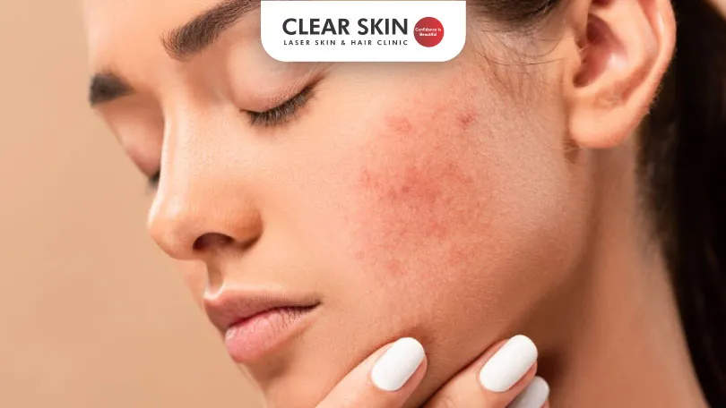 Acne-Scars-Treatment-Guide Feel Confident In Your Skin Again Clear Skin Pune