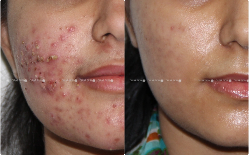 AcneScars Results 10 Sessions 9 Months ClearSkin Pune