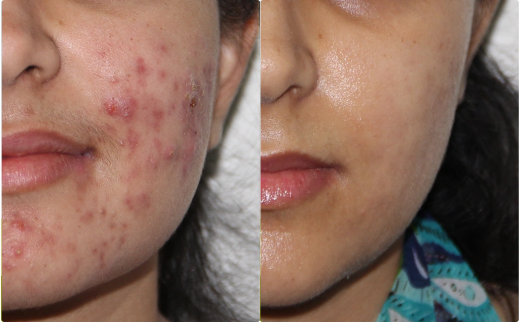 Acne Scars Results 10 Sessions 9 Months ClearSkin Pune