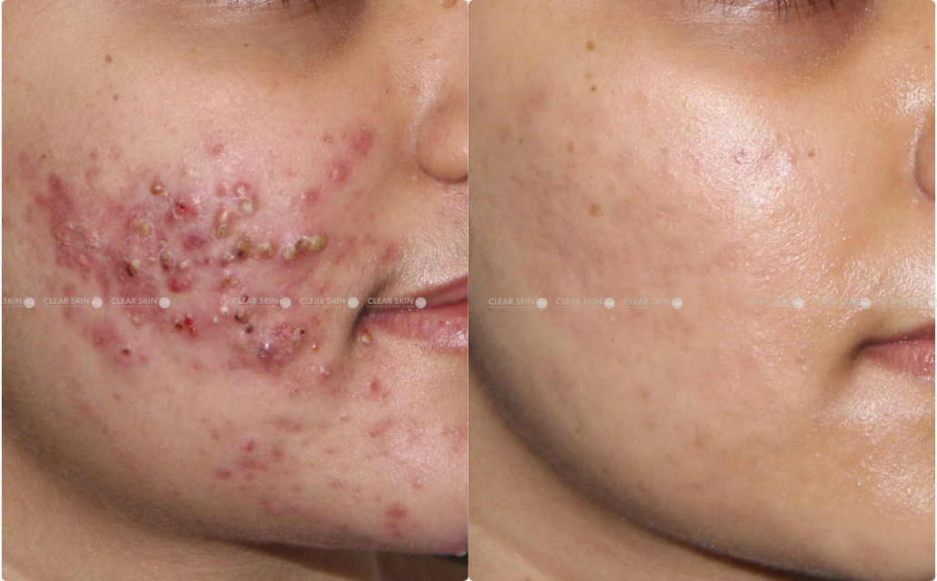 Acne Scars Results 10 Sessions 9 Months ClearSkin Pune