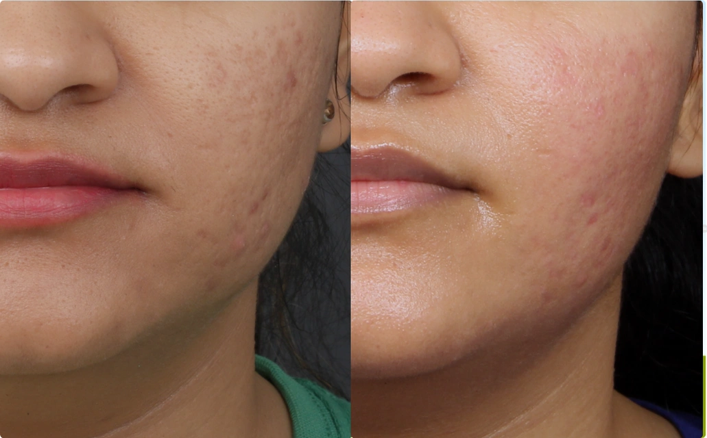 Acne Scars Results 4 Sessions 3 Months ClearSkin Pune