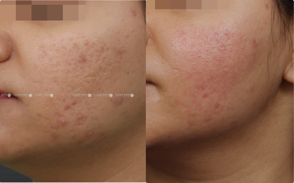 Acne Scars Results 4 Sessions 3 Months ClearSkin Pune