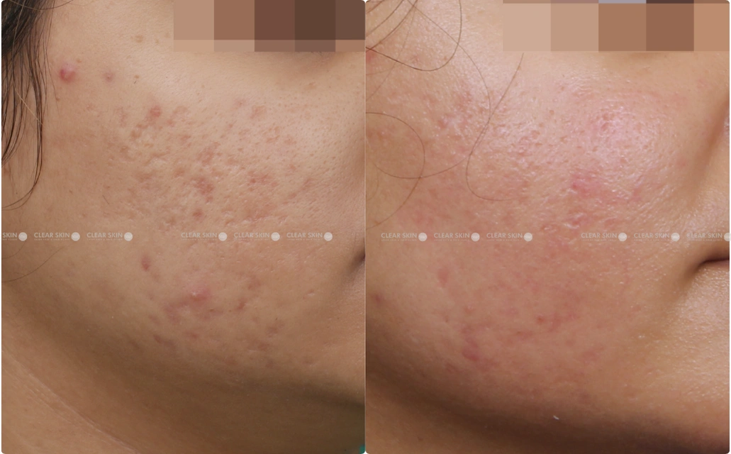 Acne Scars Results 4 Sessions 3 Months ClearSkin Pune