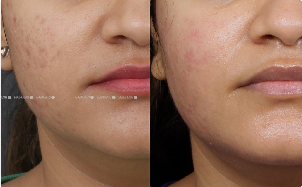 Acne Scars Results 4 Sessions 3 Months ClearSkin Pune