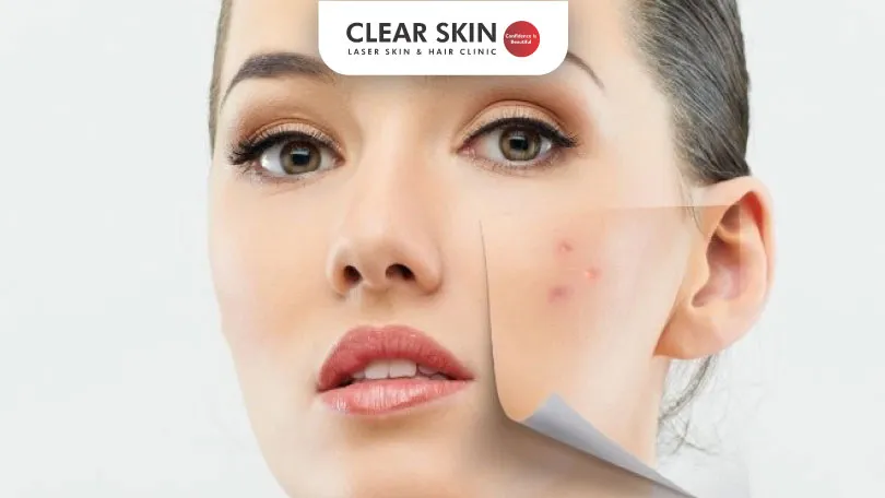 Avoid These 5 Mistakes that Cause Acne Breakout clear skin pune