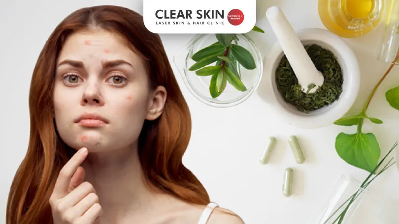 Natural Ayurvedic Solutions for Acne: Clear Your Skin with Time-Tested Remedies