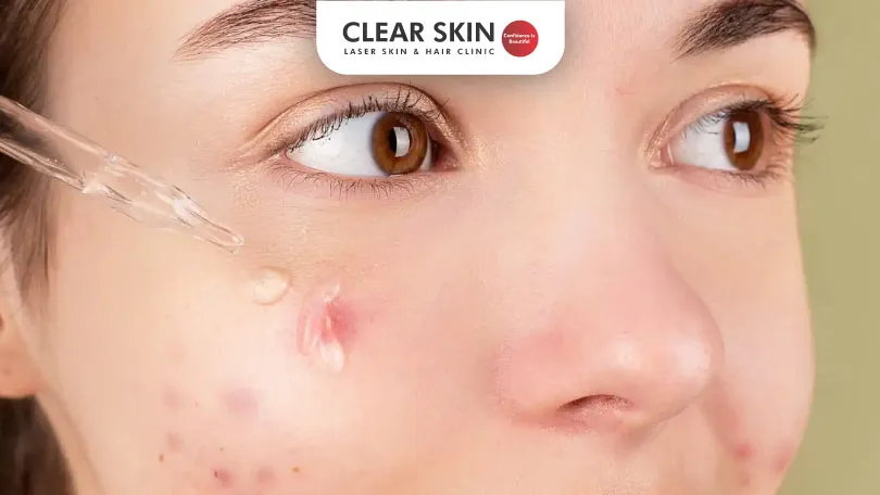 Best Serum for Acne Prone Skin Effective Ingredients and Tips Clear Skin Pune