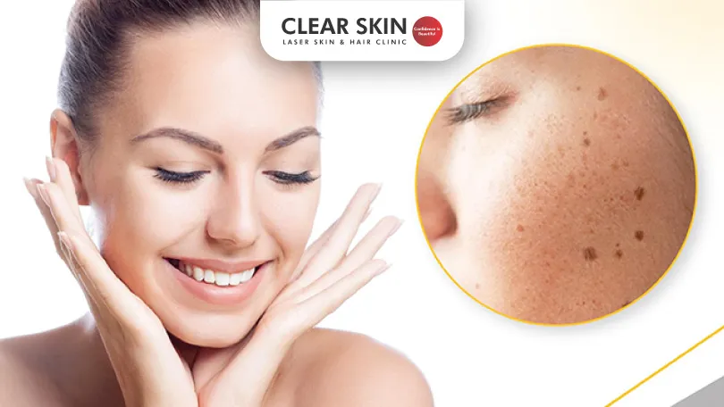 Best Treatment for Pigmentation on Face