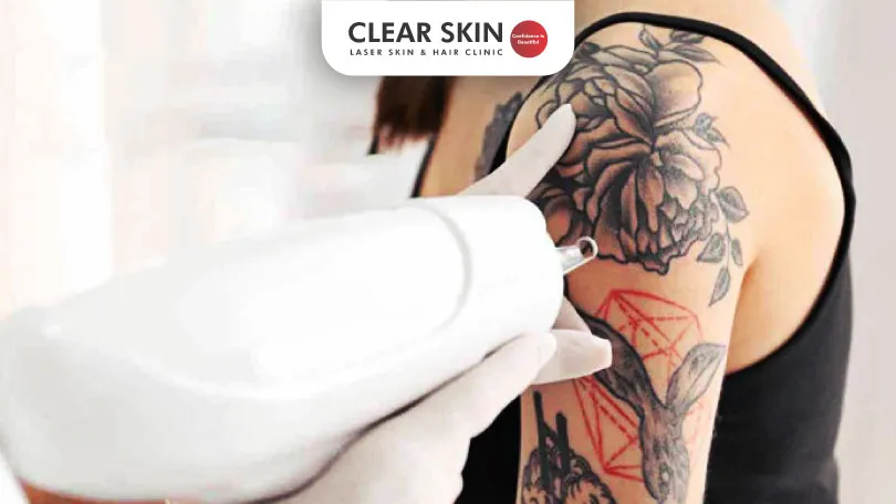 Can You Do Laser Hair Removal Over Tattoos?