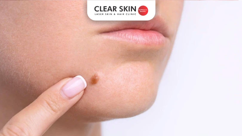 Can-moles-be-removed-by-laser