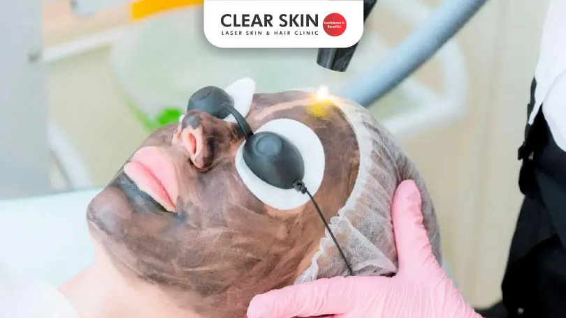 Carbon Laser Peel for Acne