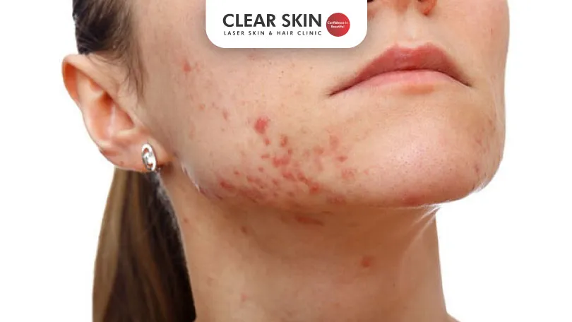 Causes and Treatment for Acne Vulgaris