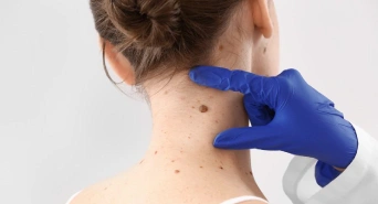 Causes of Skin Tags