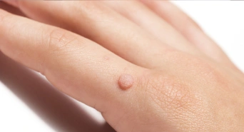 Causes of Warts