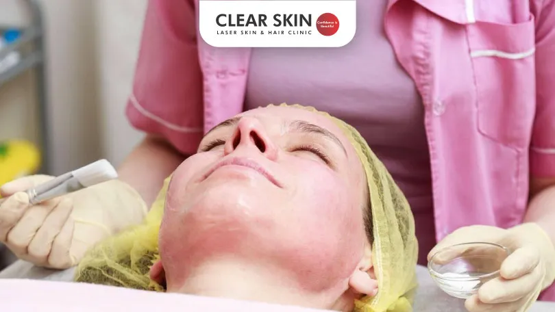 chemical peel for acne scars