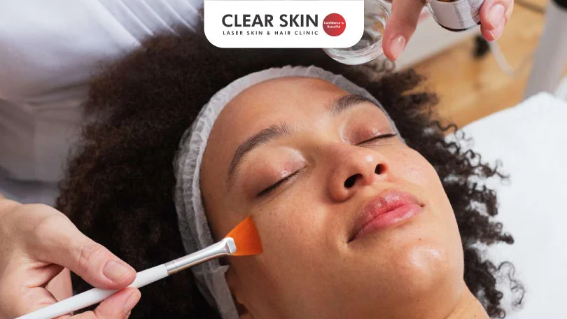 Chemical Peels for Acne Scars