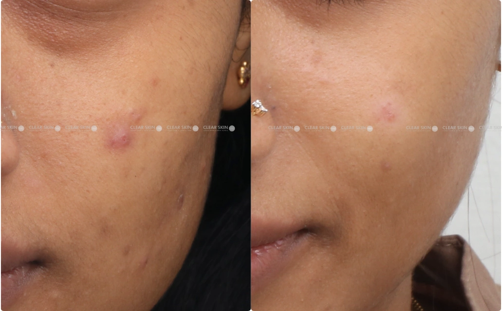 Chicken Pox Scar Results 6 Months 7 Sessions ClearSkin Pune