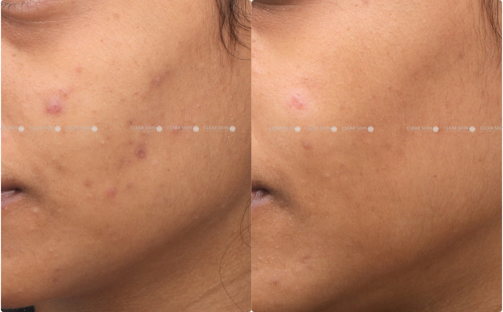 Chicken Pox Scar Results 6 Months 7 Sessions ClearSkin Pune