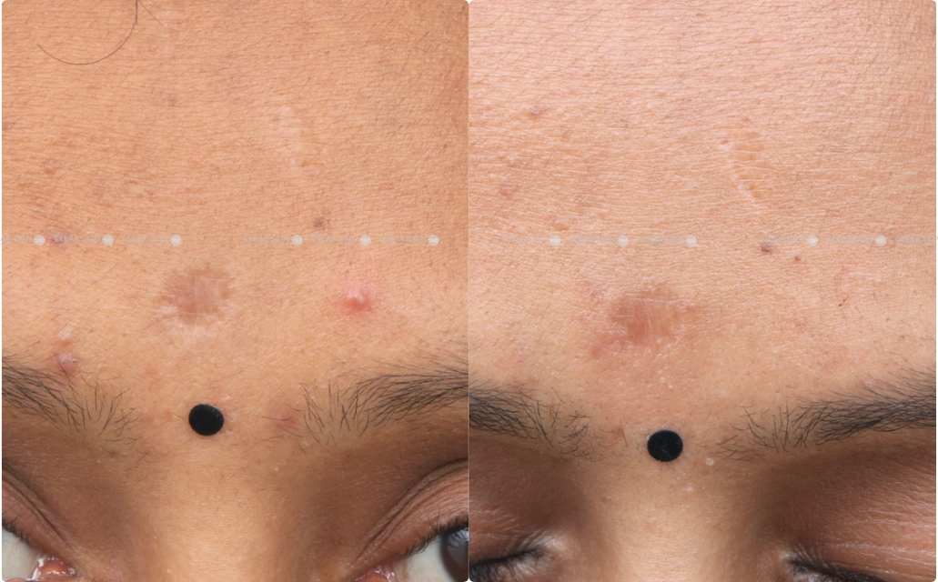 Chicken Pox Scar Results 7 Month 6 Sessions ClearSkin Pune