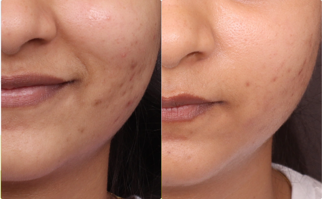 Chicken Pox Scars Results 5 Sessions 5 Months ClearSkin Pune