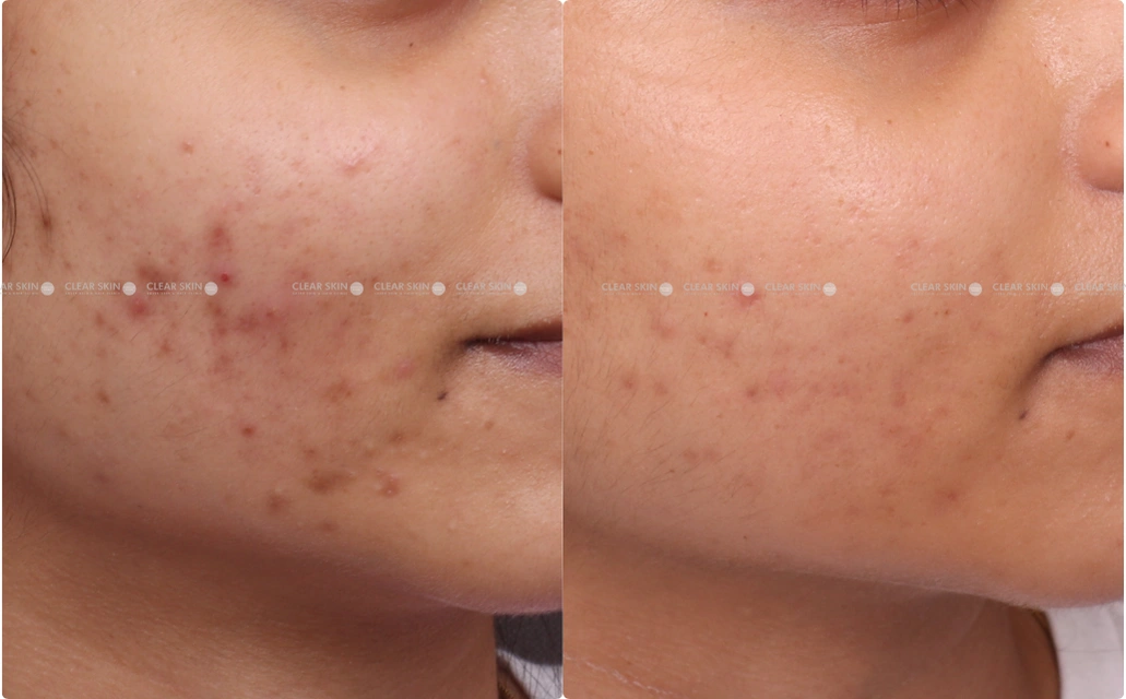 Chicken Pox Scars Results 5 Sessions 5 Months ClearSkin Pune