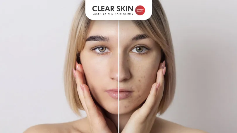 Clearing Acne Scars Causes, Treatments, and Secrets Clear Skin Pune