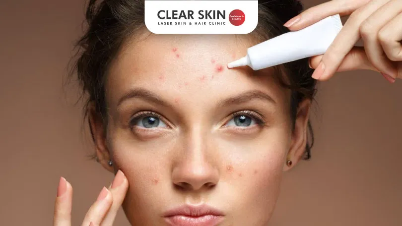 Clearing-Forehead-Acne-Fast-Dermatologist’s-Expert-Guide-clear-skin-pune