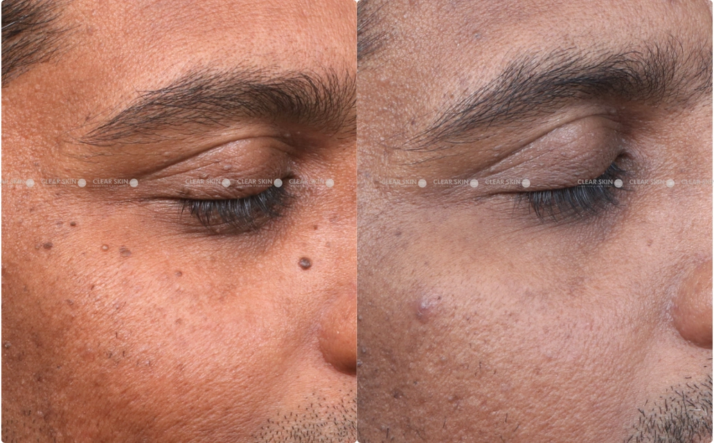 DPN Results 1 Sessions 1 Months ClearSkin Pune