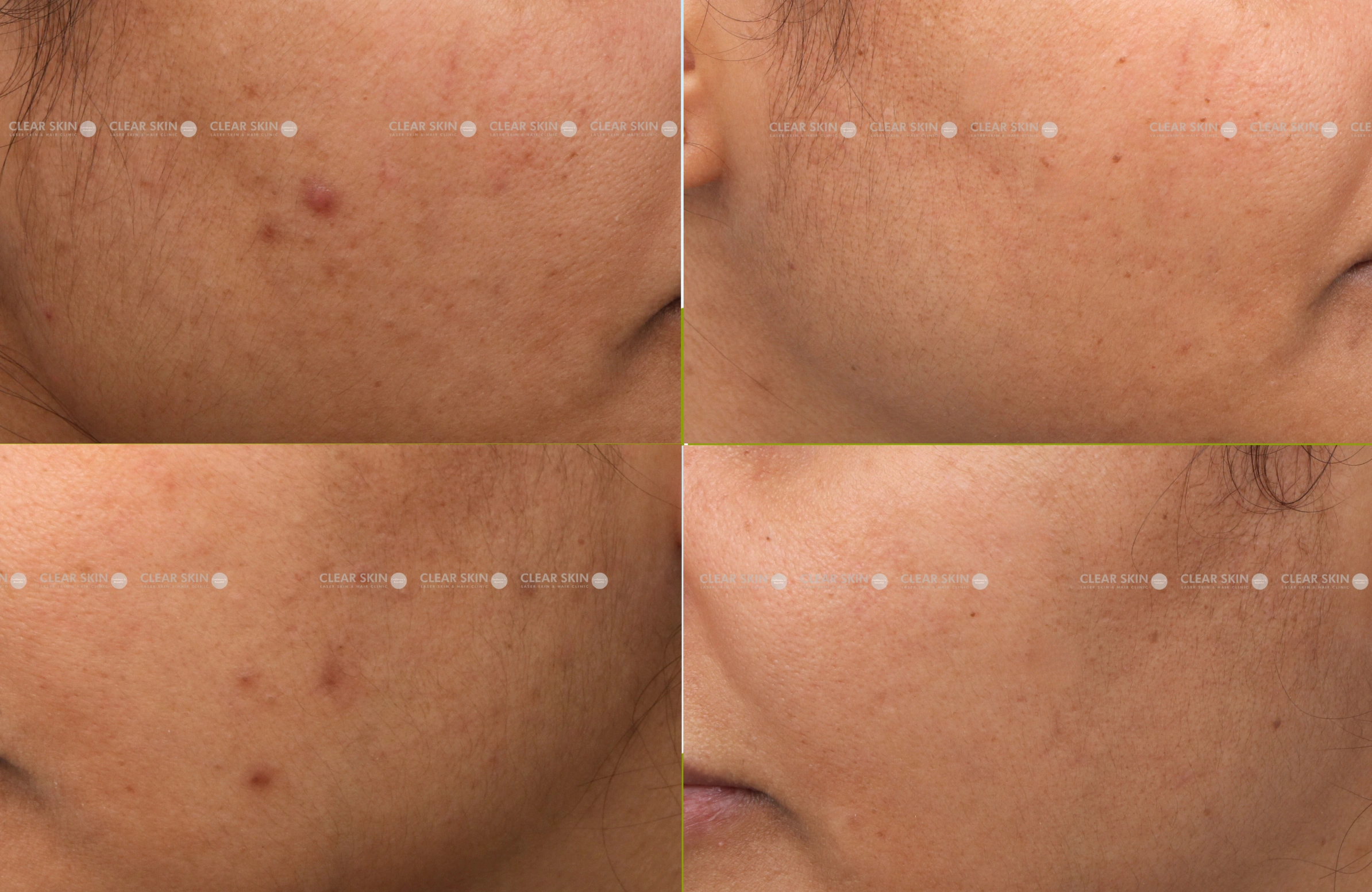 DPN Results 5 Months Timeline 4 Sessions ClearSkin Pune