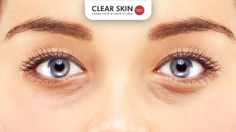 Dark Eyelids Clear Skin Pune