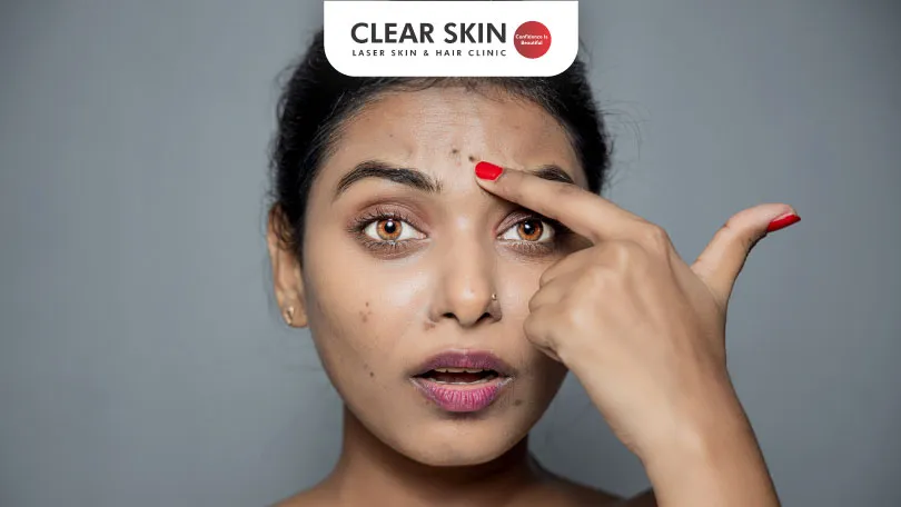 Dark Spots on Face – Removal Tips in Marathi