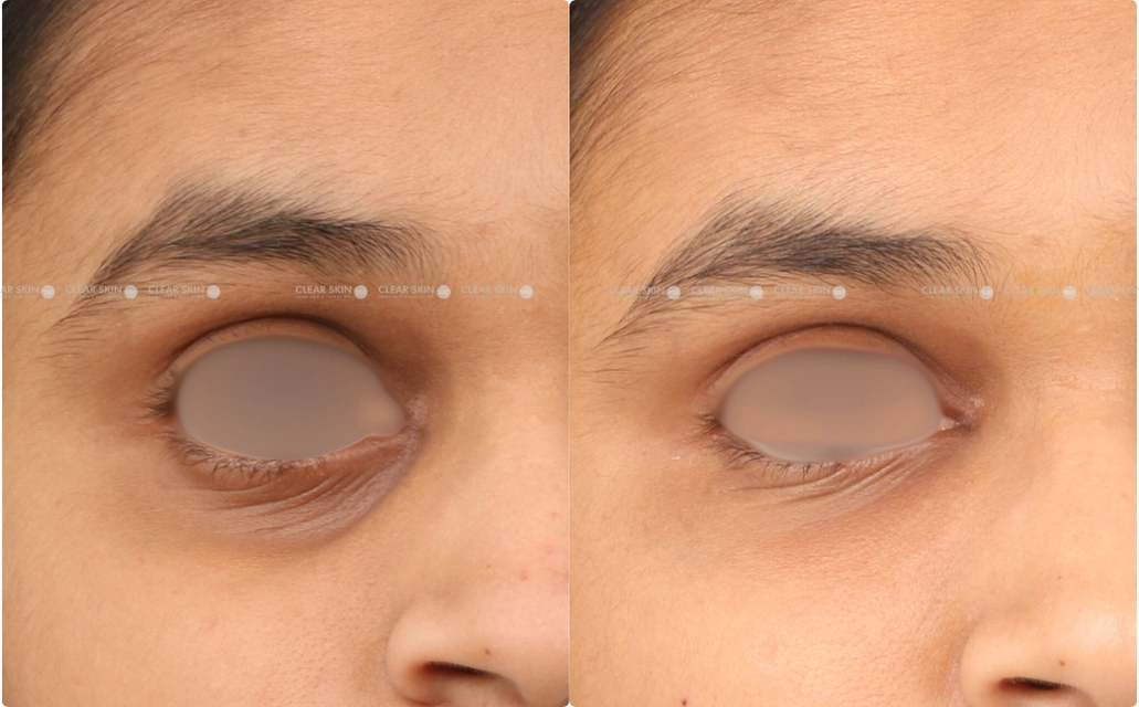 Darkcircle Results 4 Sessions 3 Months ClearSkin Pune