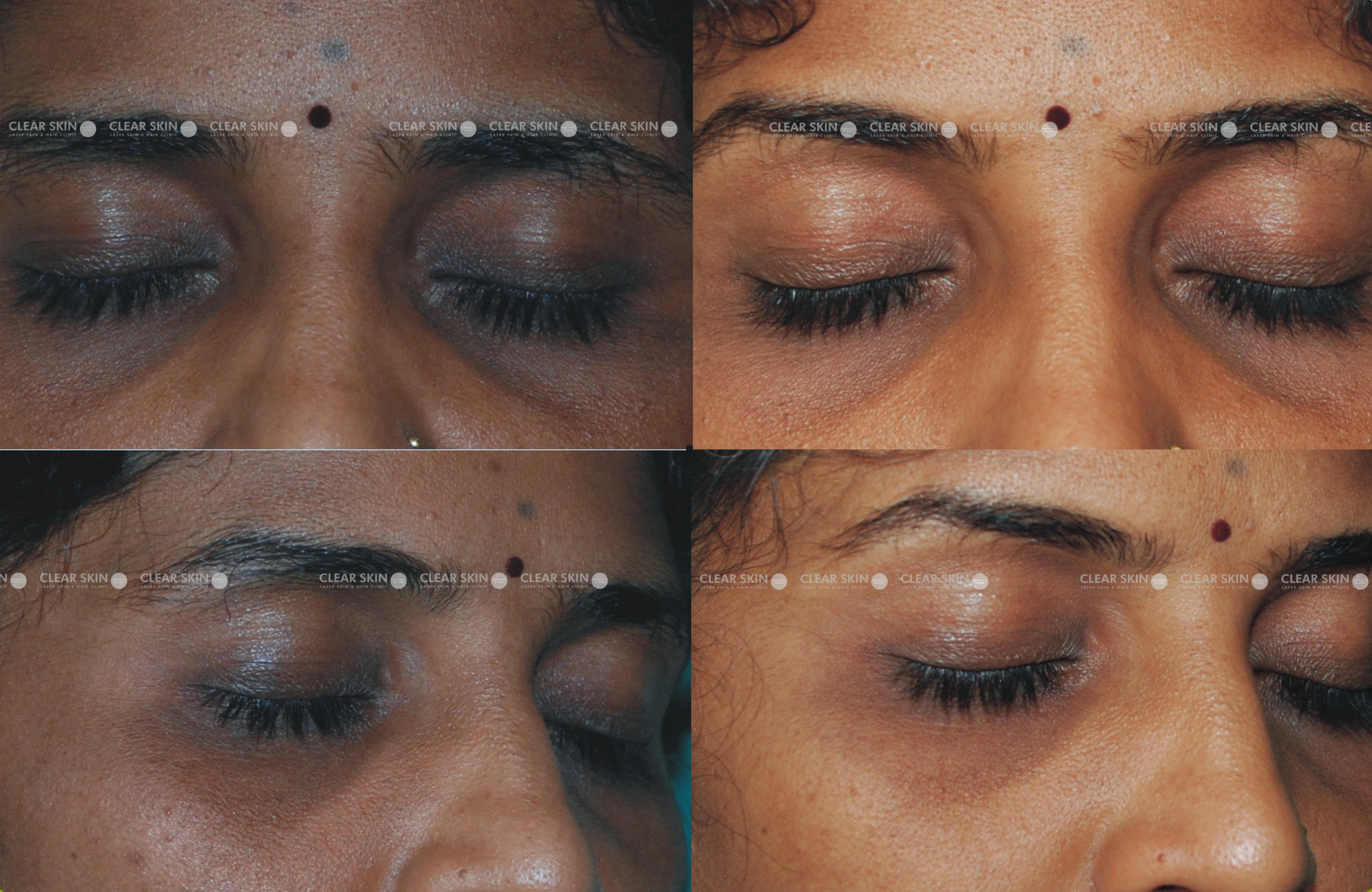 Dark Circles Results 4 Months Timeline 4 Sessions Clear Skin Pune