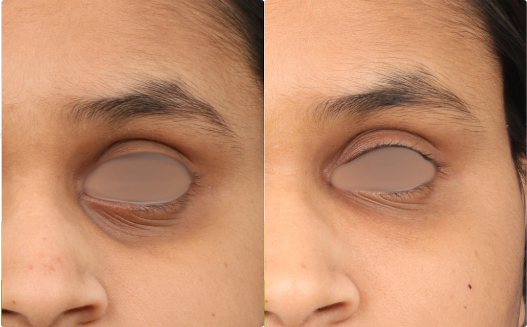 Darkcircles Results 4 Sessions 3 Months ClearSkin Pune