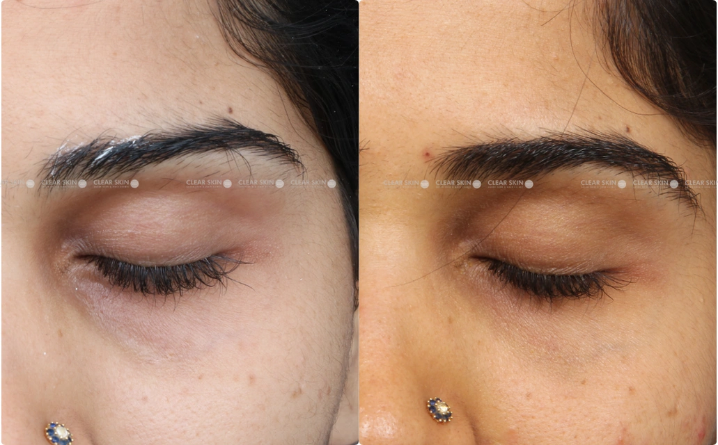 Darkcircles Results 4 Sessions 5 Months ClearSkin Pune