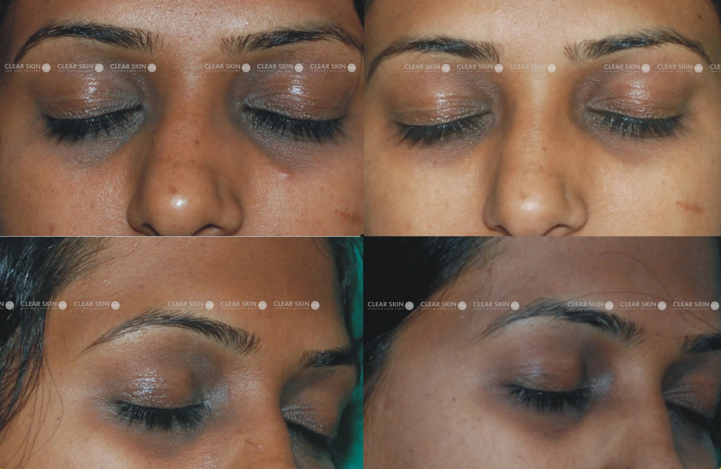 Dark Circles Results 5 Months Timeline 5 Sessions Clear Skin Pune