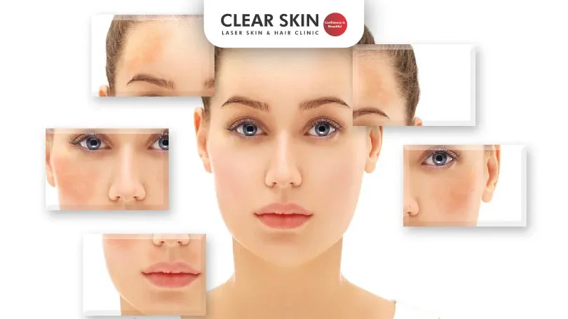 Different-Types-of-Melasma-and-How-to-Treat-Them-Clear-Skin-Pune