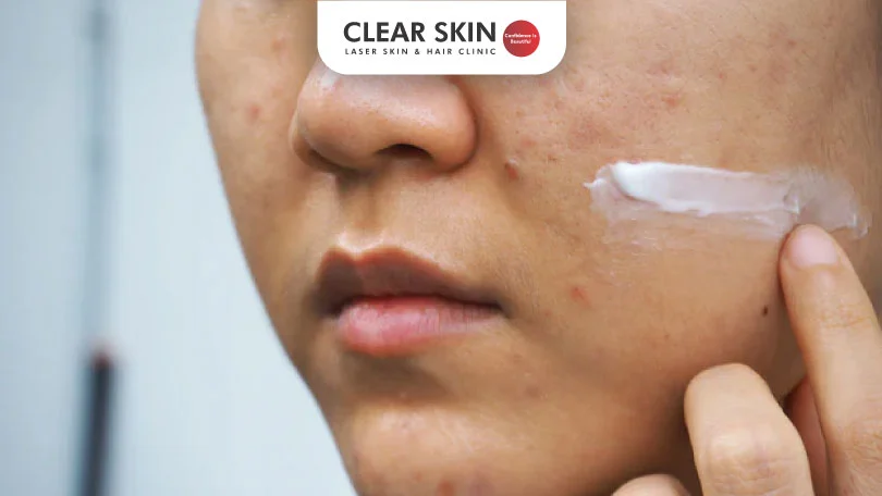 Do Acne Scar Removal Creams Really Work?